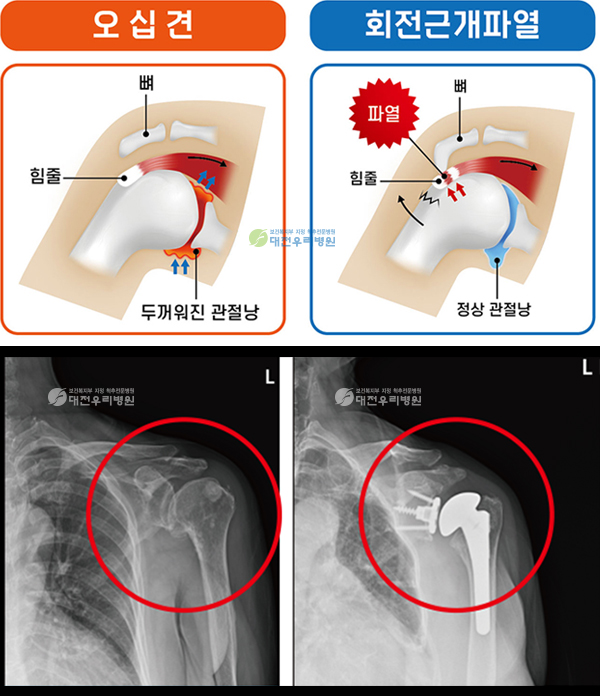 �ո񡤹߸� ���� ���� �� ��Ȱġ��